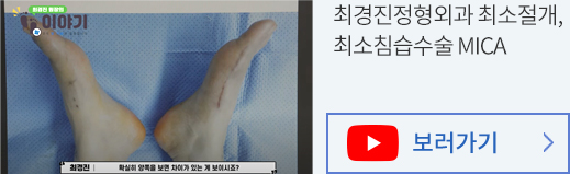 최경진정형외과 최소절개, 최소침습수술 MICA 유투브 동영상 바로가기