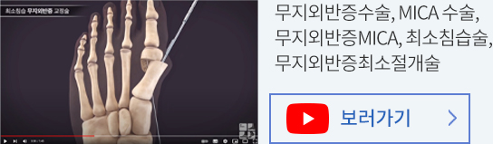최경진정형외과 무지외반증수술 유투브 동영상 바로가기